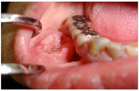 Current Aspects On Oral Squamous Cell Carcinoma ~ Fulltext