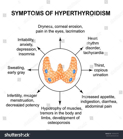 Symptoms Hyperthyroidism Thyroid Infographics Vector Illustration