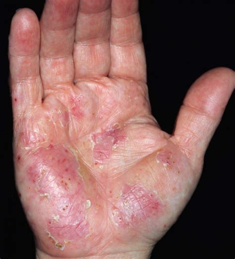 Dyshidrotic Eczema Finger