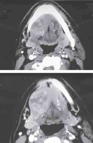 Submandibular Gland Tumors Salivary Gland Pathology Mitch Medical