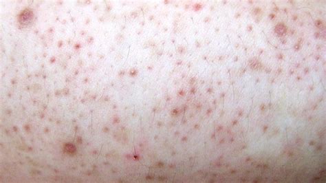 Comb Yarn Pathological Bumpy Rash On Bottom Rainy Soap Ratio
