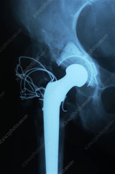 Total Hip Replacement X Ray Stock Image M6000297 Science Photo