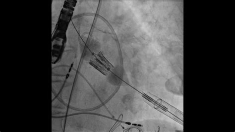 Tavr Transcatheter Aortic Valve Replacement Transapical Deployment