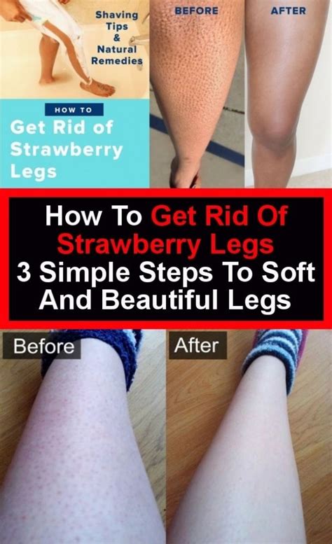 How To Get Rid Of Strawberry Legs Three Simple Steps Strawberry Legs