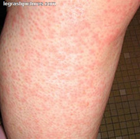 Red Rash On Leg Not Itchy Pictures Photos