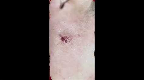 Cyst Removal From Cheek Youtube