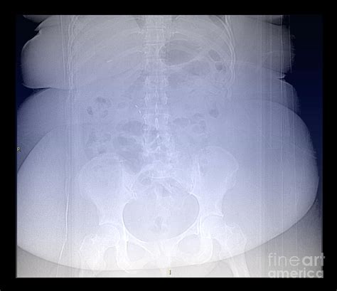 X Ray Of Morbidly Obese Patient Photograph By Living Art Enterprises