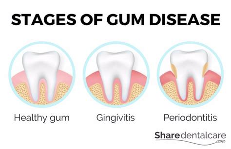 Gum Disease Symptoms Causes And More Overview Share Dental Care