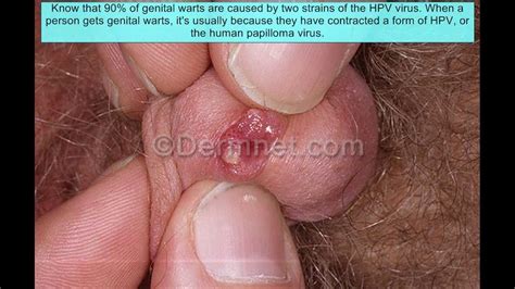 Nude Dick With Warts