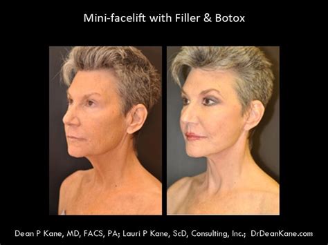 Dr Dean Kane Performed A Facelift For This 59 Year Old Woman From