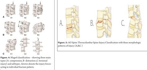 Types Of Thoracic Fractures Design Talk