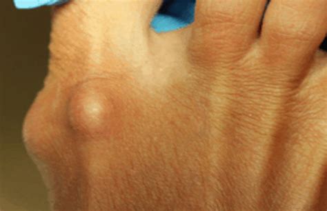 Skin Conditions Northwest Foot Ankle Ps
