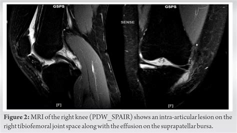 A Rare Case Of Synovial Chondromatosis Of Knee With Both Intra