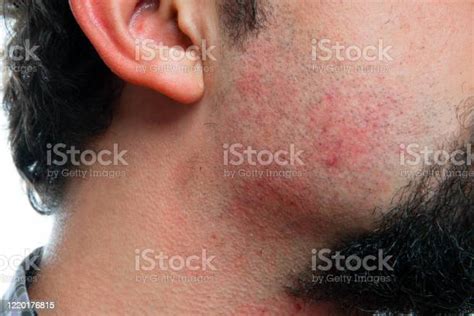 Closeup Portrait Of A Irritation After Shaving On The Neck Of A Man