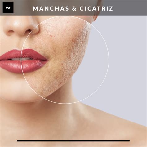 Fotofacial Secuelas De Acne Cicatriz Beauty Enhance Spa