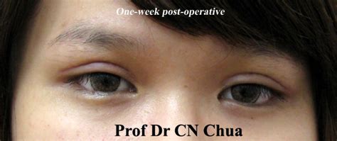 Kotlus always holds a clear respect for the patient's natural anatomic features and seeks to enhance rather than to redesign. Eyelid Surgery by Prof Dr CN CHUA 蔡鐘能: Allergy to Tapes ...