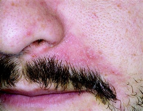 Seborrheic Dermatitis Around Nose
