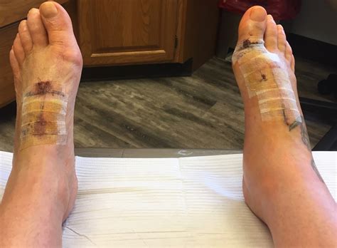 Before During And After Bunion Surgery Bunion Surgery And Hardware