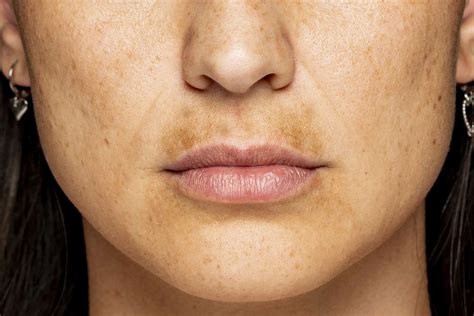 How To Clear Dark Spots On Your Lips