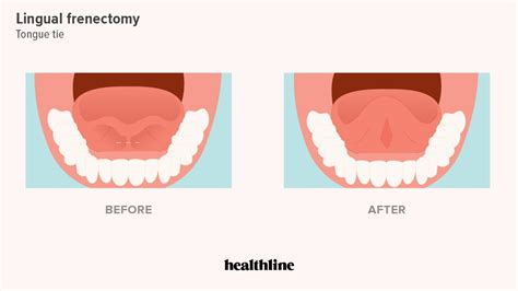 Laser Frenectomy Lower Lip Recovery