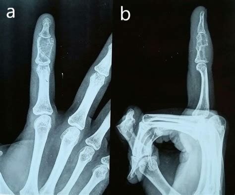 A And B Preoperative Radiographic Images Showing Giant Cell Tumor