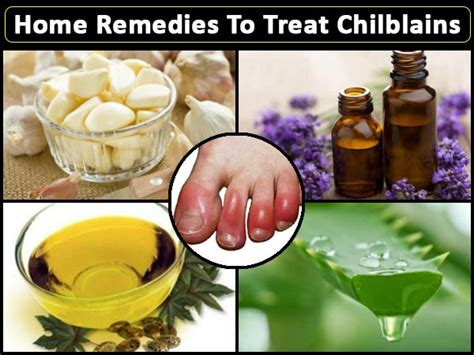 Home Remedies For Chilblains How To Cure Chilblains Naturally Best