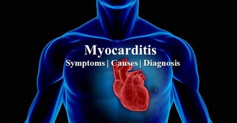 We did not find results for: Myocarditis - Causes, Symptoms and Diagnosis | Dr Sarat
