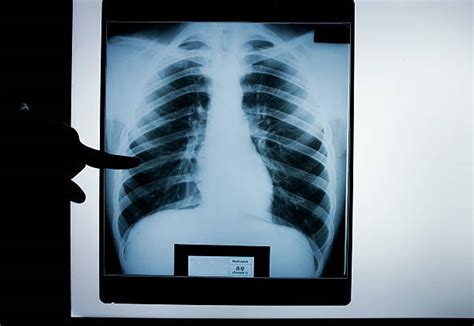 120 Normal Lung X Ray Stock Photos Pictures And Royalty Free Images