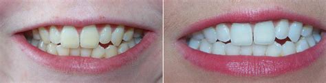 Are Your Pearlies Looking Less Than White Read Our Whitening Advice