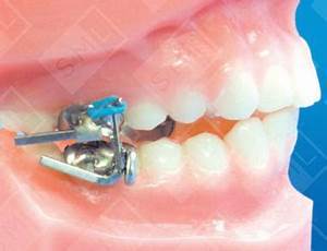 Mara Molar Correction Dentist Lab Tools Sml