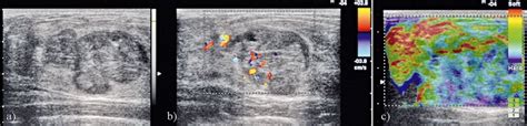 Complex Fibroadenoma Appearing On Ultrasound As A Lobulated Mass With
