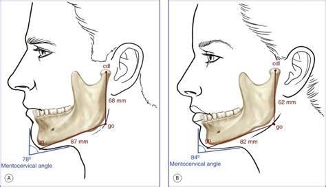 Mandible Pocket Dentistry