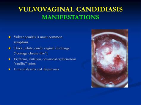 Ppt Gynecological Infections Powerpoint Presentation Free Download