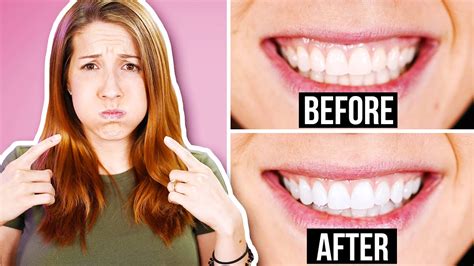 Oil Pulling Before And After Teeth