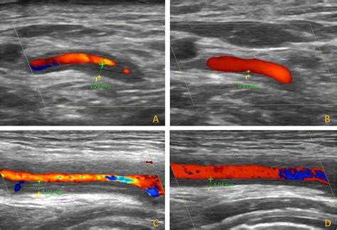 Ultrasound Halo Sign As A Potential Monitoring Tool For Patients With