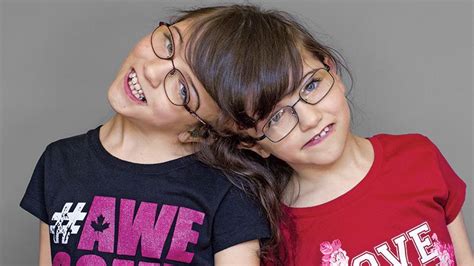 These Conjoined Twins Have The Ability To See Through Each Others Eyes