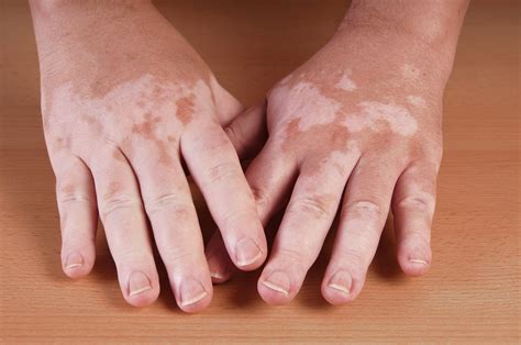 Understanding Vitiligo In Children Early Symptoms And Causes