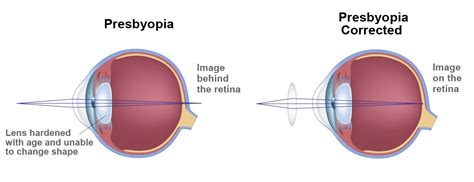 Presbyopia Causes Monterey Ca