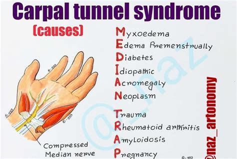 Carpal Tunnel Syndrome Causes Medizzy
