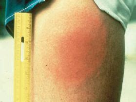 We did not find results for: A Review of Tick Bites in Pictures