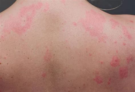 What Causes Hives In Adults Symptoms Treatment