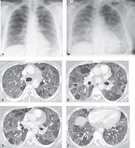 104 Acute Interstitial Pneumonia Aip Radiology Key