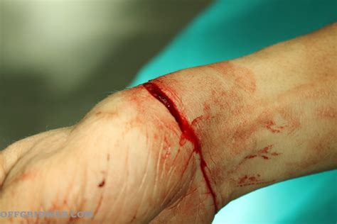 How To Suture Diy Guide To Wound Closure Methods Survival Magazine