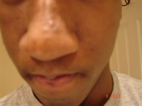 How To Get Rid Of These Bumps On My Nose General Acne Discussion