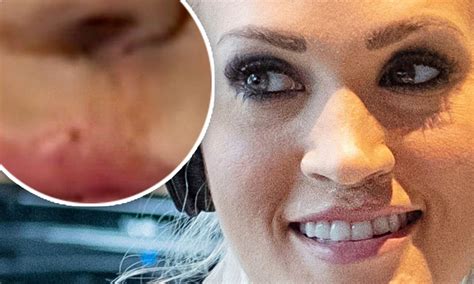 Carrie Underwood Before And After Accident Face Scars