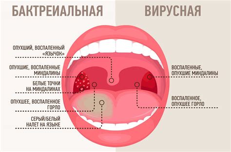 Виды Ангин И Их Характеристики Таблица Фото — Картинки фотографии