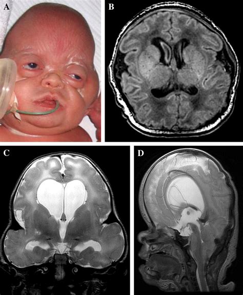 Beare Stevenson Syndrome Two Dutch Patients With Cerebral