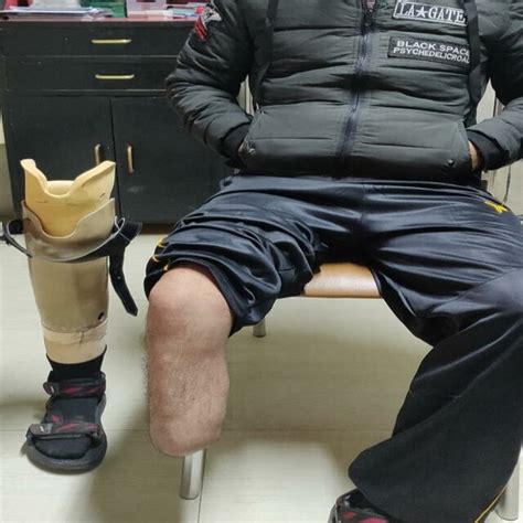 Case 1 Below Knee Amputation With Below Knee Prosthesis At 18 Months