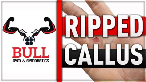Ripped Hands How To Deal With Ripped Calluses Bullgng Gymnastics