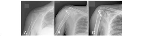 Varus Angulation Of The Humeral Surgical Neck Fracture In A Patient Who